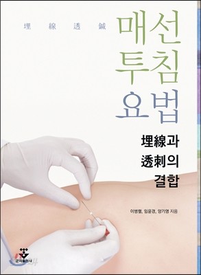 매선투침요법