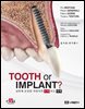 TOOTH or IMPLANT?