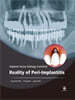 Reality of Peri-Implantitis