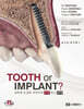 TOOTH or IMPLANT?