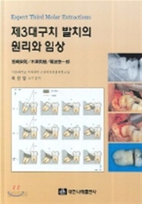 제3대구치 발치의 원리와 임상