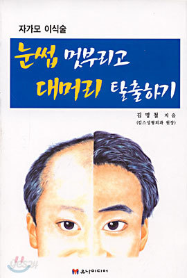 눈썹 멋부리고 대머리 탈출하기 : 자가모이식술