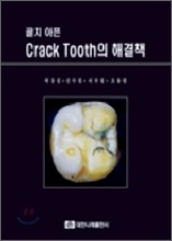 골치 아픈 Crack Tooth의 해결책