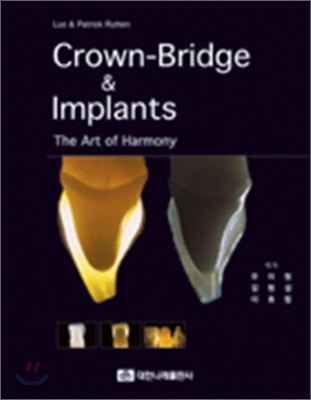 CROWN-BRIDGE AND IMPLANTS