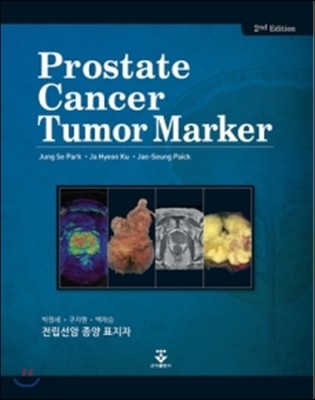 전립선암 종양 표지자