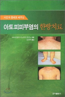 아토피피부염의 한방치료