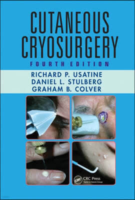 Cutaneous Cryosurgery