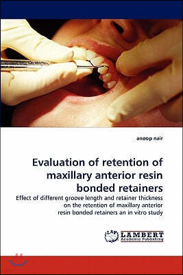 Evaluation of Retention of Maxillary Anterior Resin Bonded Retainers