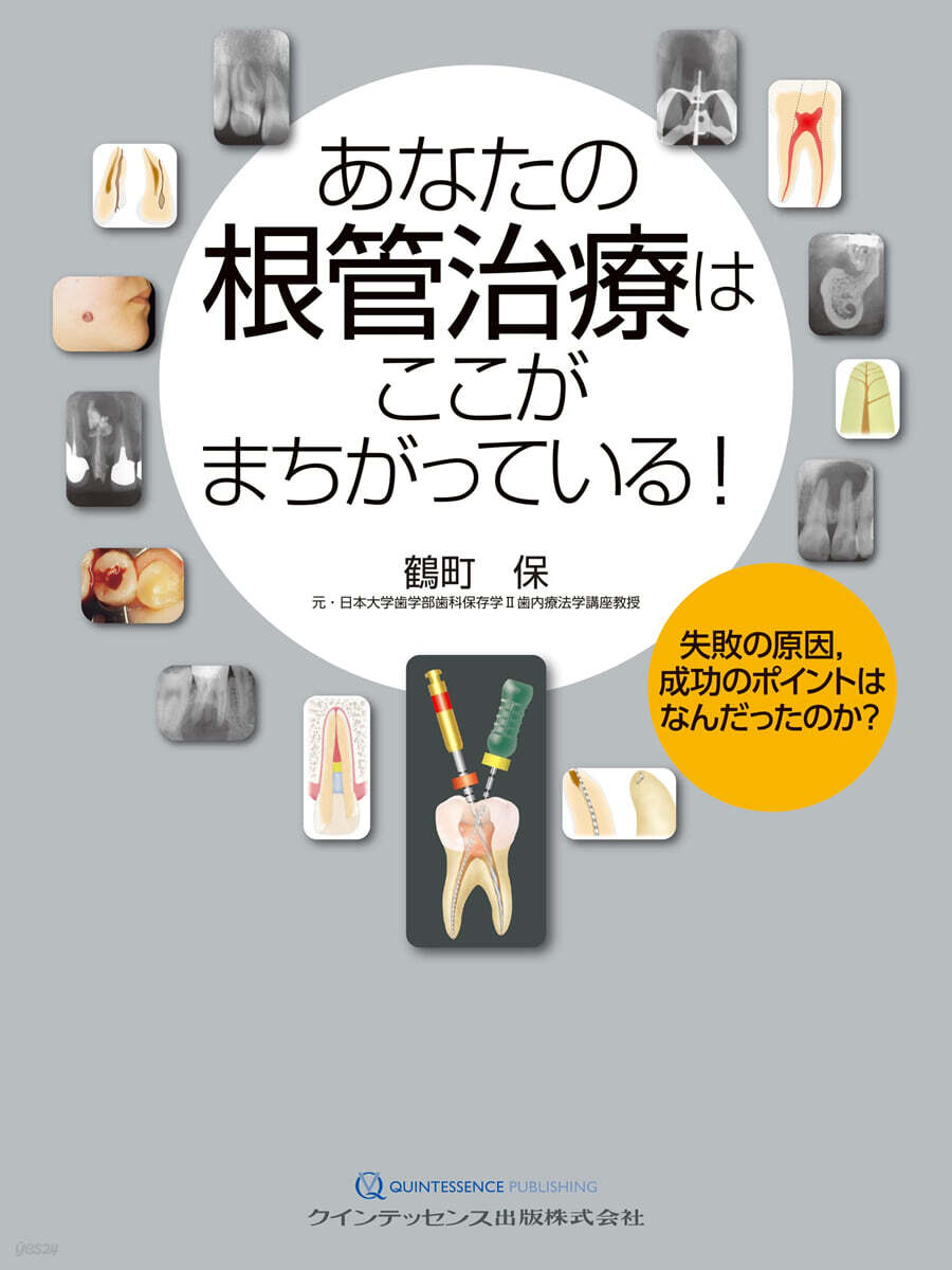 あなたの根管治療はここがまちがっている! : 失敗の原因, 成功の