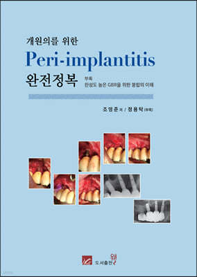 Ǹ  Peri-implantitis 