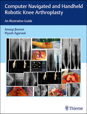 Computer Navigated and Handheld Robotic Knee Arthroplasty: An Illustrative Guide