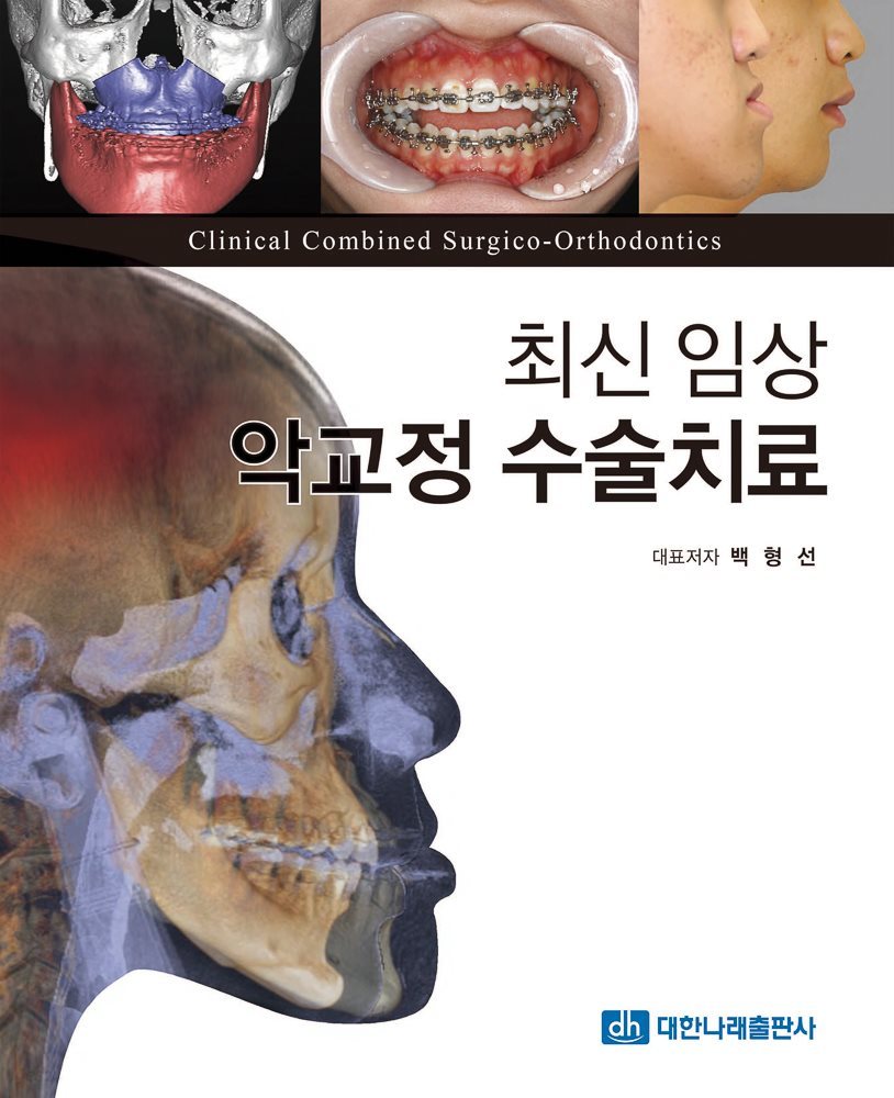 최신 임상 악교정 수술치료