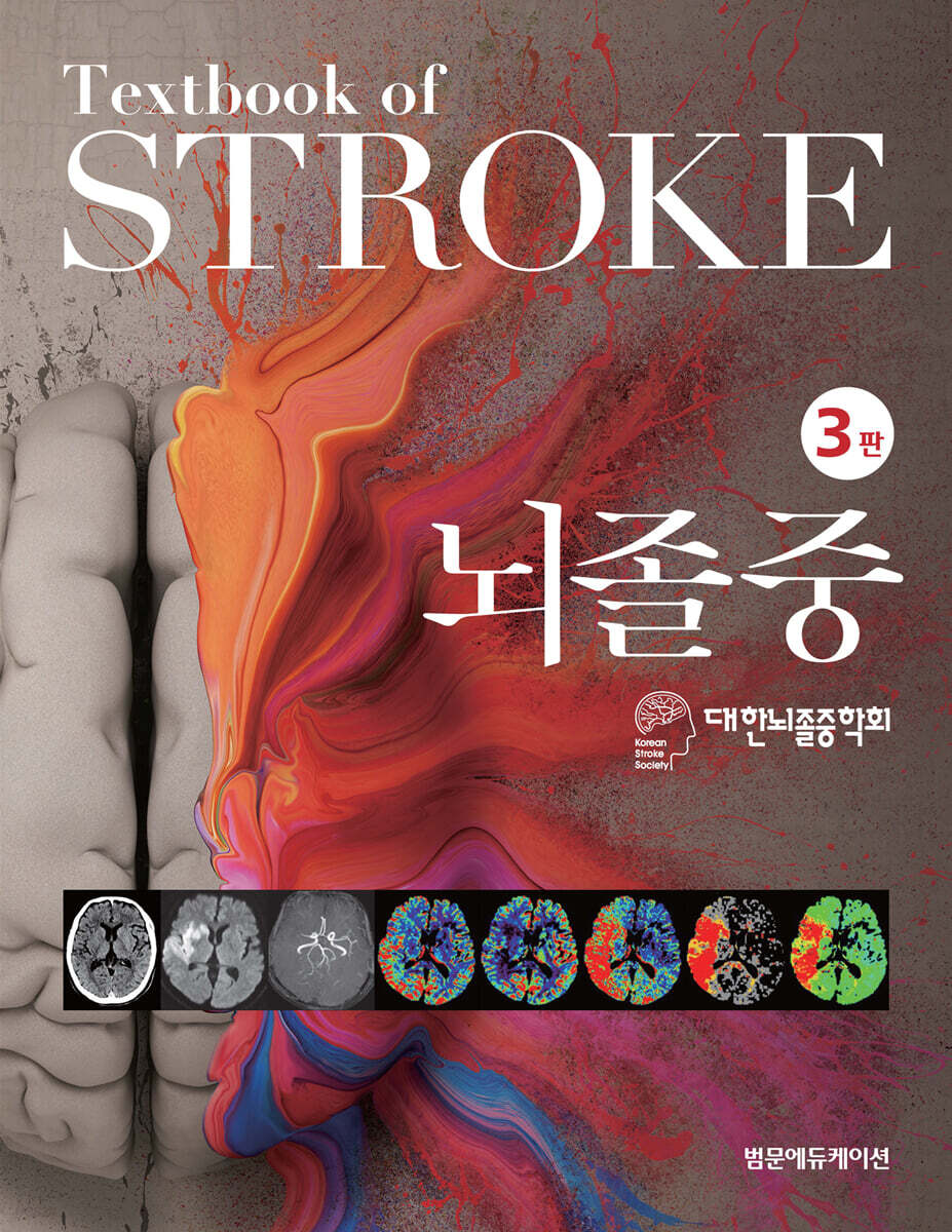 뇌졸중