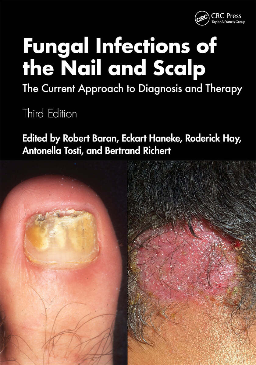 Fungal Infections of the Nail and Scalp