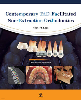 Contemporary TAD-Facilitated Non-Extraction Orthodontics