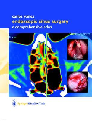 Endoscopic Sinus Surgery: A Comprehensive Atlas