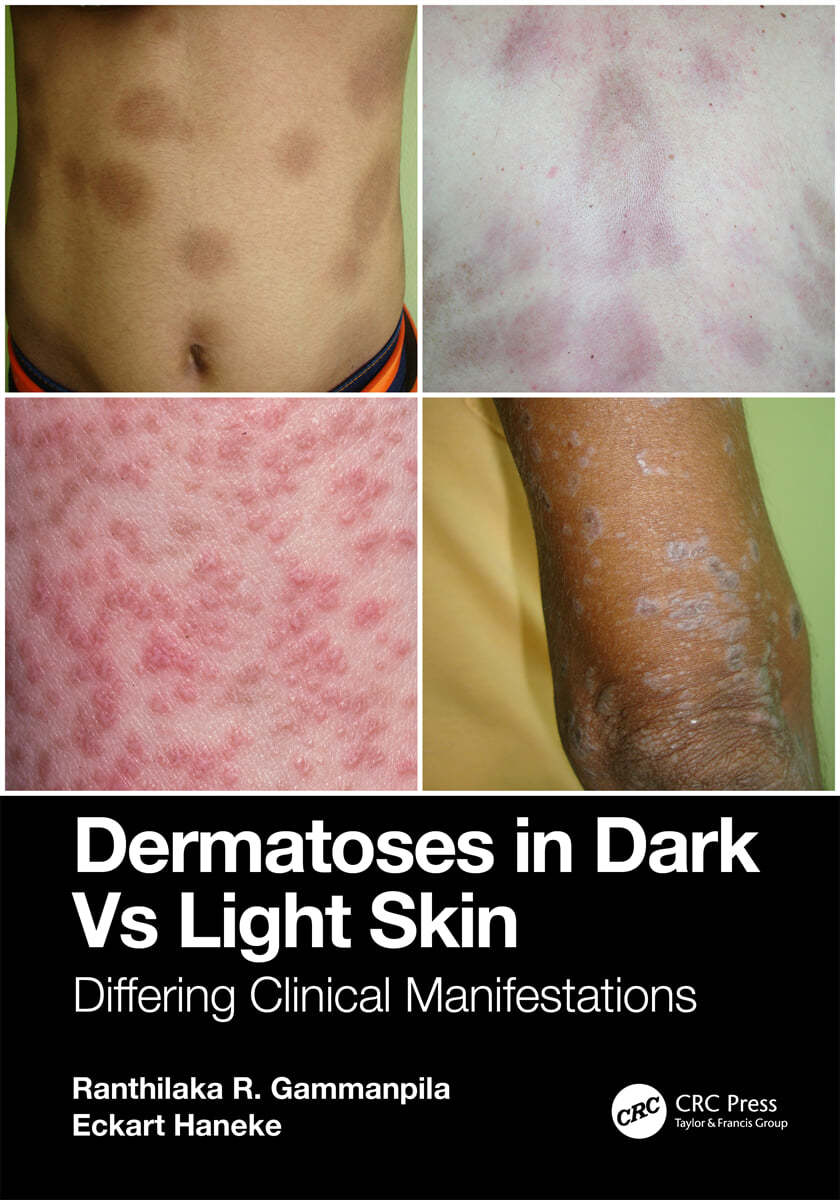 Dermatoses in Dark Vs Light Skin