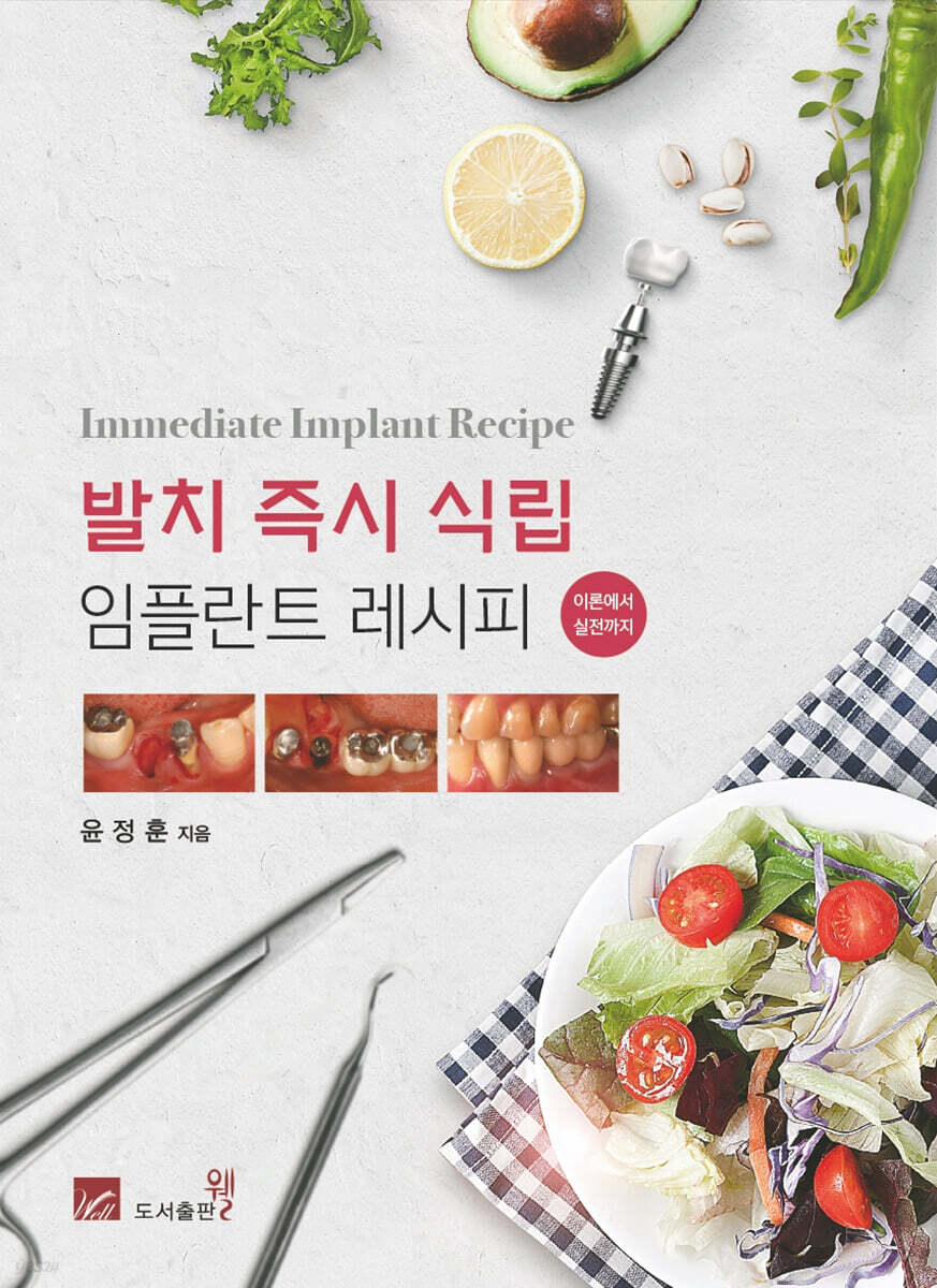 발치 즉시 식립 임플란트 레시피