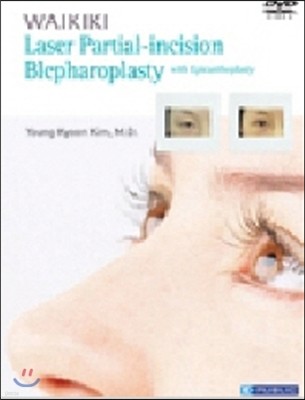 Waikiki Laser Partial-Incision Blepharoplasty (DVD)
