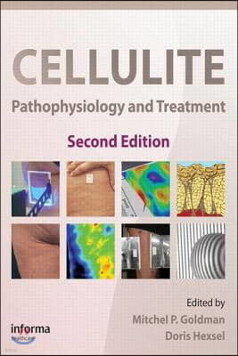 Cellulite: Pathophysiology and Treatment