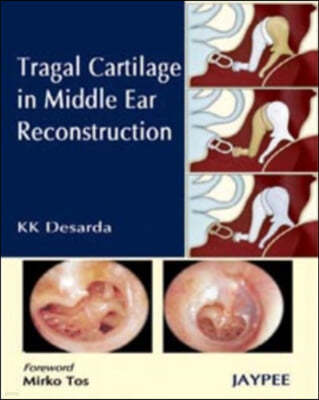 Tragal Cartilage in Middle Ear Reconstruction