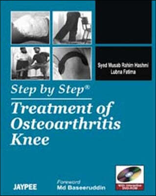 Step by Step: Treatment of Osteoarthritis Knee