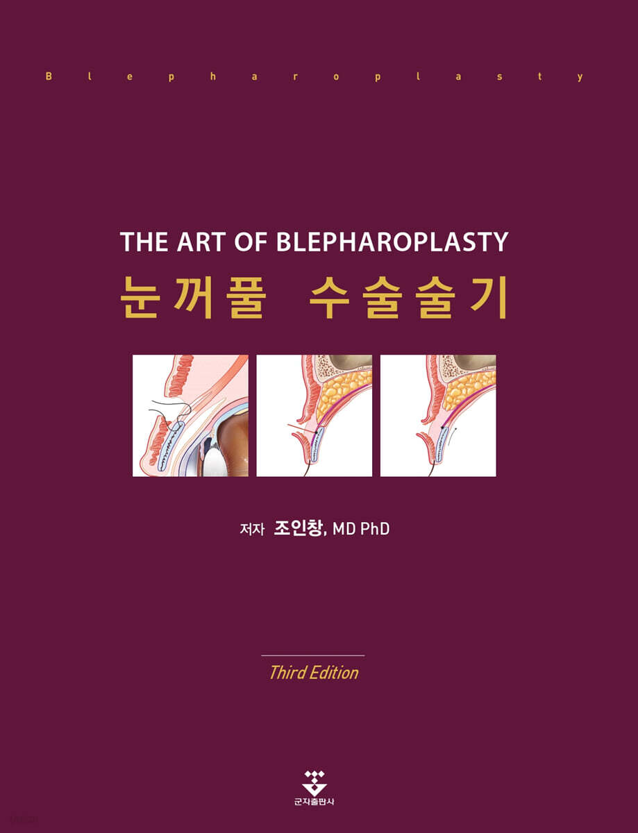 눈꺼풀 수술술기