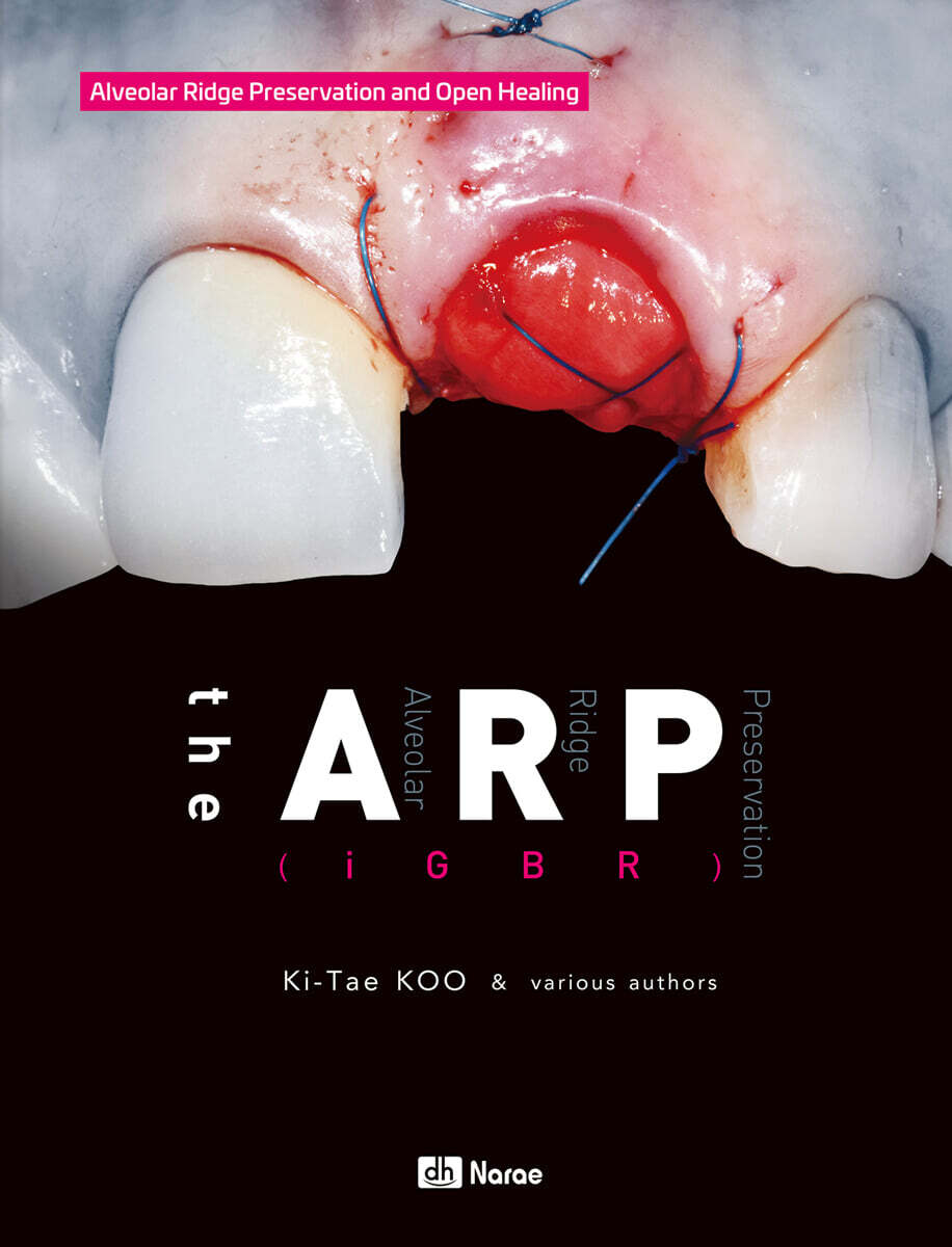 the ARP(iGBR)