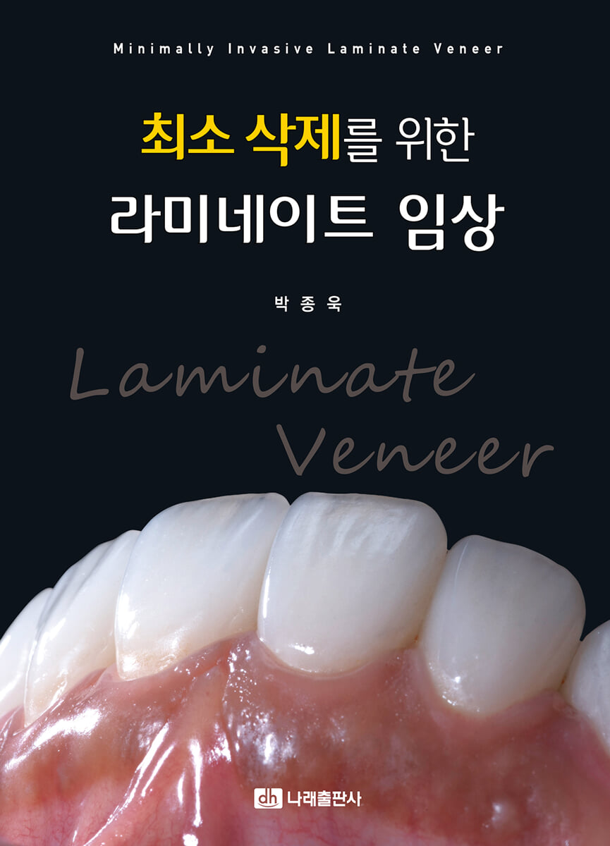 최소 삭제를 위한 라미네이트 임상