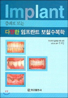 증례로 보는 다양한 임플란트 보철수복학