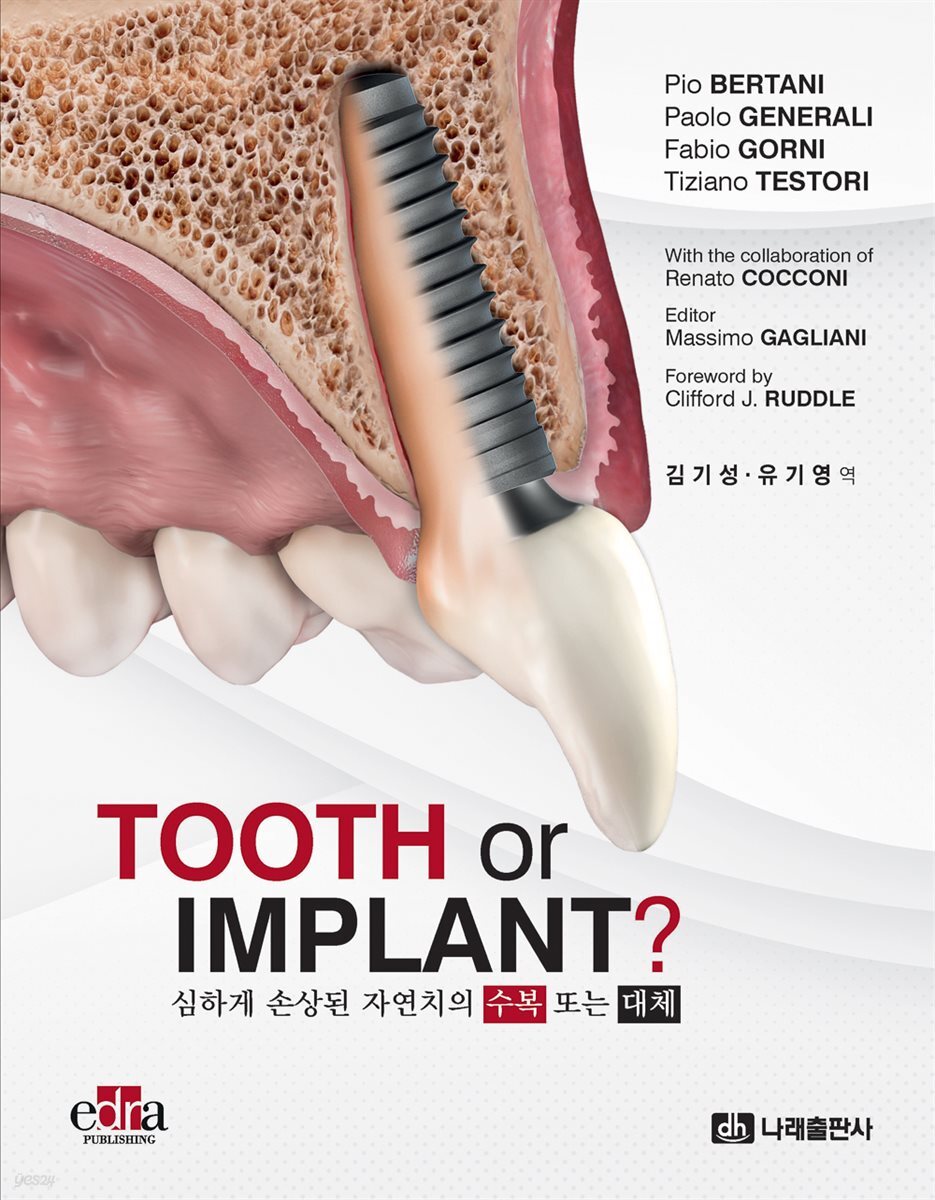 TOOTH or IMPLANT?