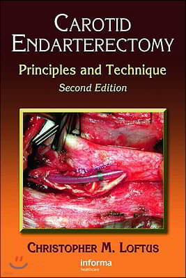 Carotid Endarterectomy: Principles and Technique