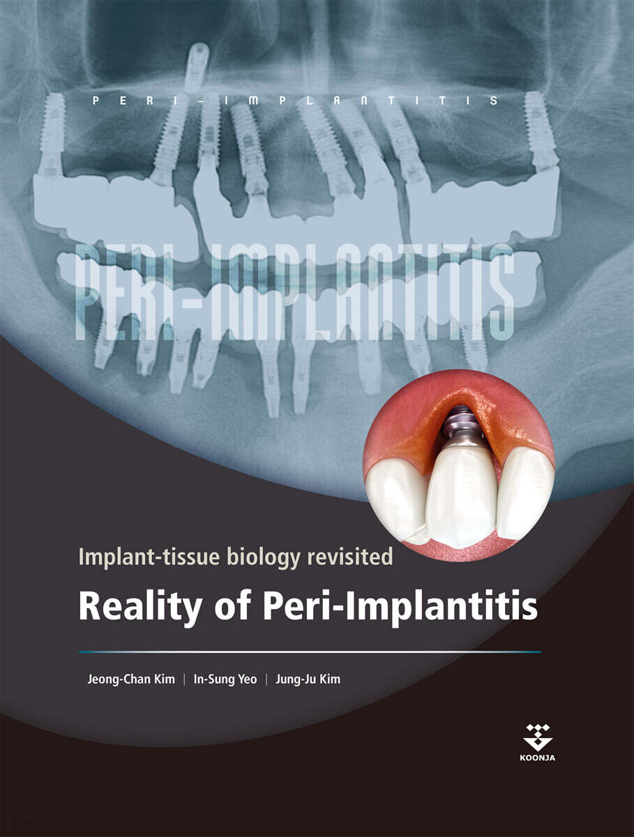 Reality of Peri-Implantitis