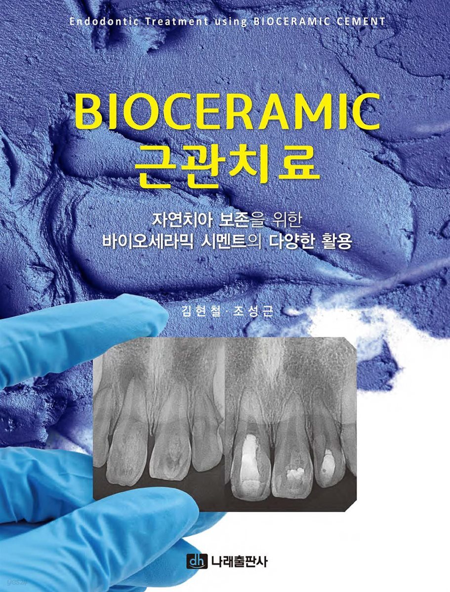 BIOCERAMIC 근관치료