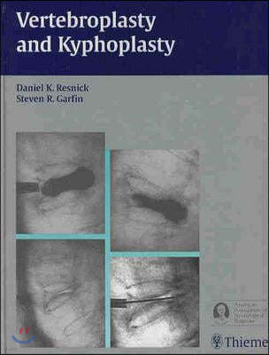 Vertebroplasty and Kyphoplasty