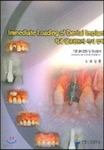 Immediate Loading Of Dental Implant