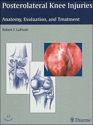 Posterolateral Knee Injuries