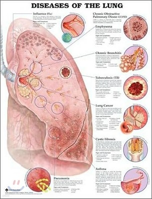 Diseases of the Lung Anatomical Chart