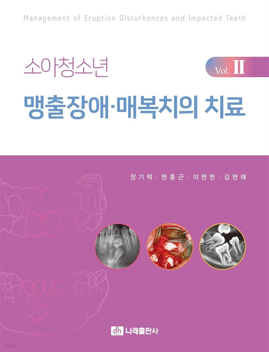 소아청소년 맹출장애·매복치의 치료 Vol. II