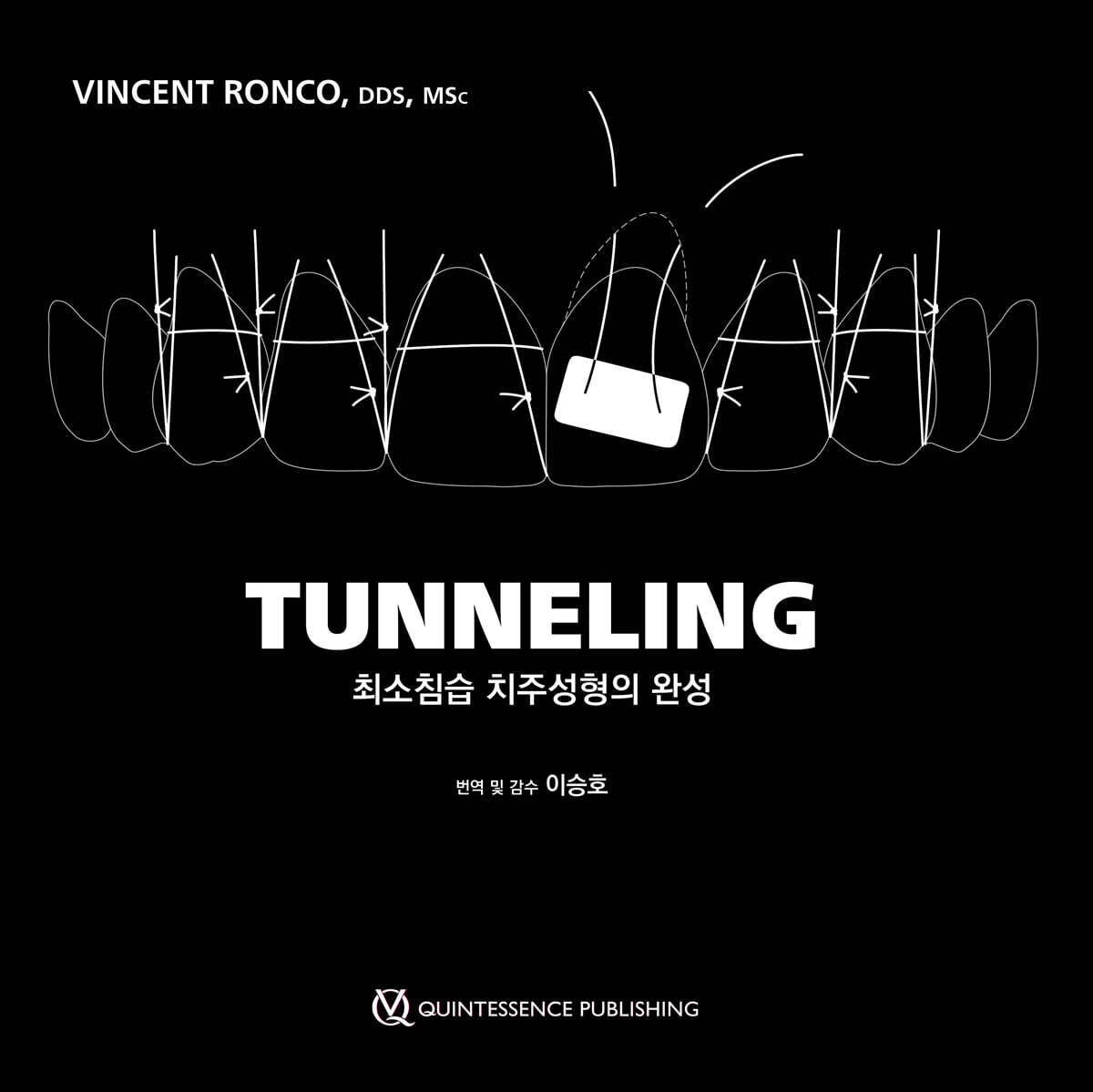 TUNNELING 최소침습 치주성형의 완성