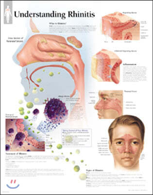 Understanding Rhinitis Laminated Poster