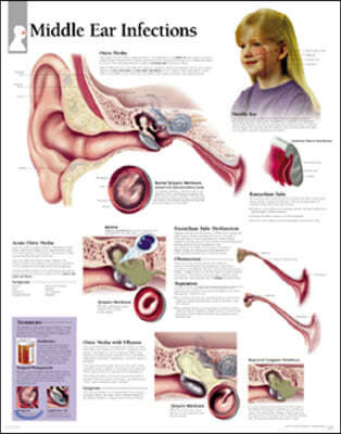 Middle Ear Infections Laminated Poster
