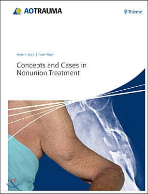 Concepts and Cases in Nonunion Treatment