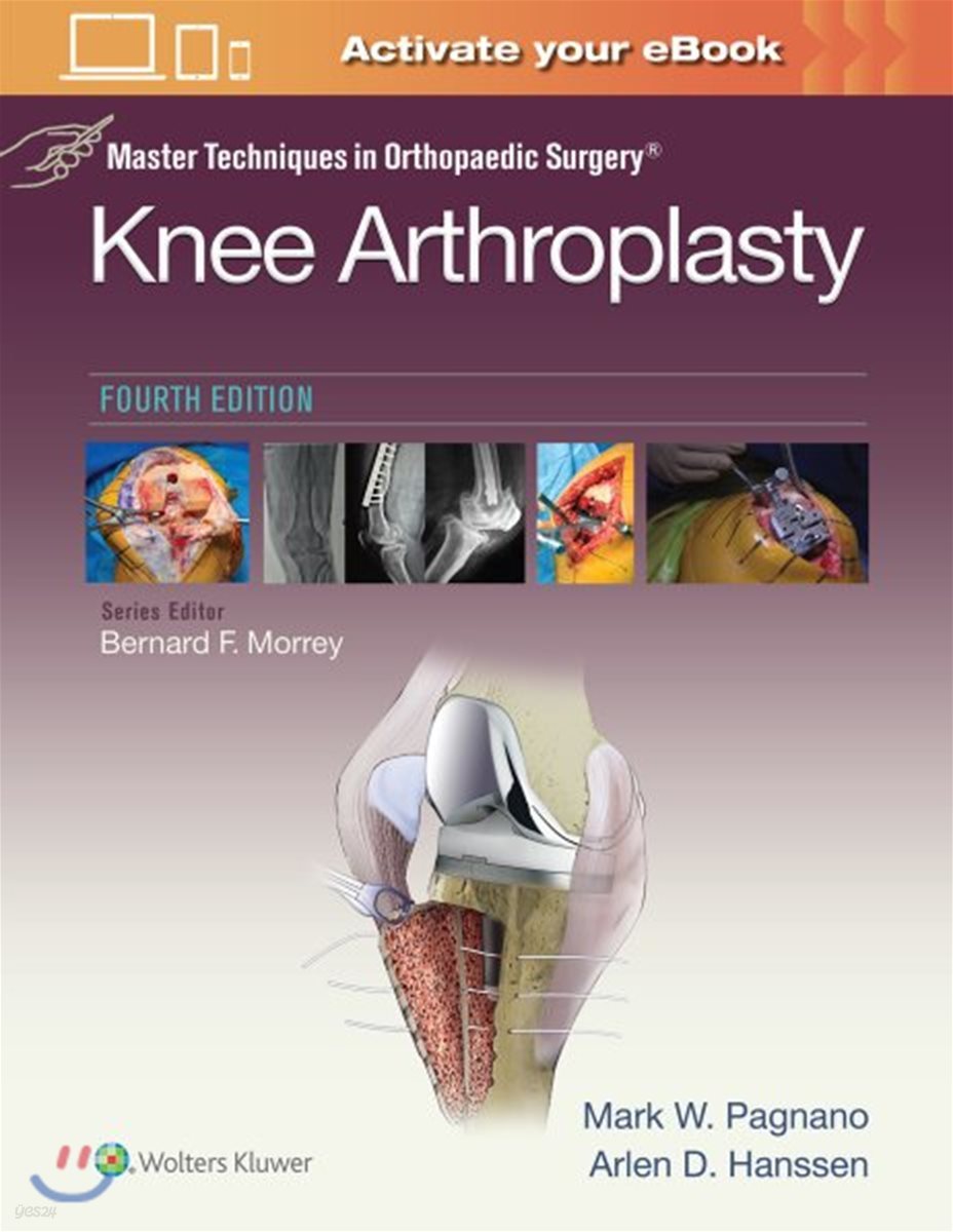 Knee Arthroplasty