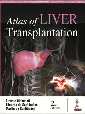 Atlas of Liver Transplantation