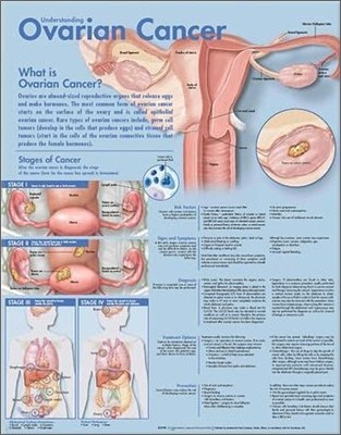 Understanding Ovarian Cancer Anatomical Chart