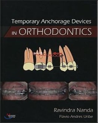 Temporary Anchorage Devices in Orthodontics