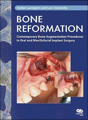 Bone Reformation: Contemporary Bone Augmentation Procedures in Oral and Maxillofacial Implant Surgery