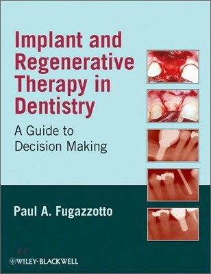 Implant and Regenerative Thera