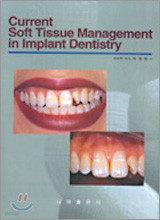 Current Soft Tissue Management In Implant Dentistry